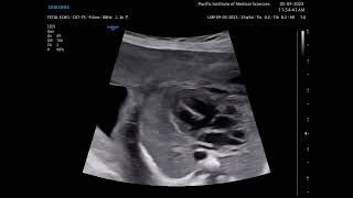 TETRALOGY OF FALLOT FETAL ECHO ULTRASOUND [upl. by Azpurua]