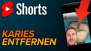 Karies freilegen shorts [upl. by Swaine]