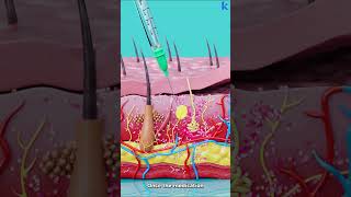 How Subcutaneous Injection Works [upl. by Iorgo]