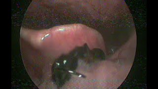 Laryngoscopy  Insect  Ant  Removal from Larynx [upl. by Erme723]