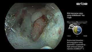 ESD of a LSTNG tumor at the splenic flexure using HYBRIDknife® flex IType [upl. by Annayak]