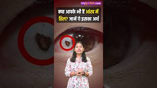 Mole On Eyes जानें आंख के अंदर तिल होना किस बात की ओर करता है इशारा। mole on inside eyes। [upl. by Einnahpets]