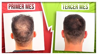 RECUPERA SU PELO en 3 MESES con DUTASTERIDE y MINOXIDIL ORAL [upl. by Ymaral544]