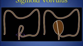 Cecal and sigmoid volvulus version 1 0 edit [upl. by Inahpets]