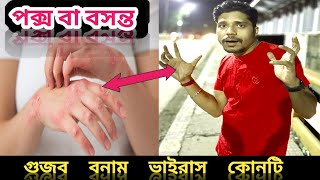 পক্স বা বসন্ত।পক্স বা বসন্ত কী। pox ki virus। গুজব vsভাইরাস কোনটি 🤔 [upl. by Boak]