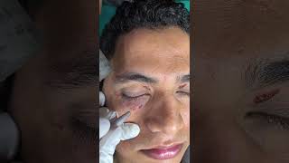 Eyes Fat Xanthelasma best laser treatment Dermatologist Dr Sandesh Gupta darkcirclesundereyes [upl. by Karil]