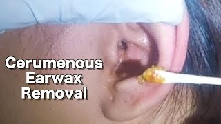 Girls Cerumenous Earwax Removal amp Ear Cleaning [upl. by Etnelav]