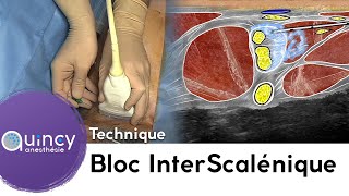 Le Bloc InterScalénique [upl. by Eniowtna]