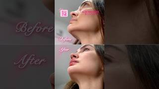 👄 Lips amp Chin Augmentation Enhance Your Natural Beauty [upl. by Ecnarf]