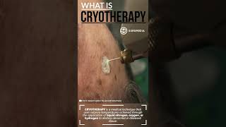 What is Cryotherapy Cryoablation or Cryosurgery medical mole skintreatment skin cryo [upl. by Roselani]