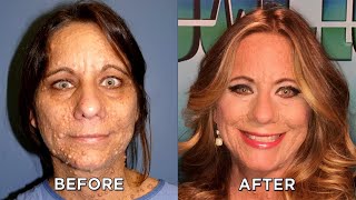 New Confidence for Woman Post Tumor Removal [upl. by Guise]