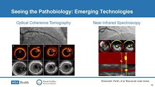 Dr Rushi Parikh quotImproving outcomes following hospitalization for heart failure what’s newquot [upl. by Salsbury]