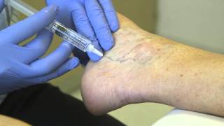 Spider Vein Treatment  Sclero Therapy [upl. by Ahsenauj]