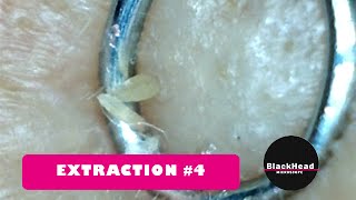 Whitehead and BlackHead RemovalExtraction 4 Reedit [upl. by Avron924]