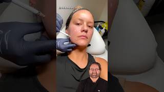 Face Lift Using Fillers Surgeon Reacts [upl. by Luzader]