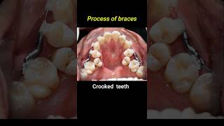 Crooked teeth braces process braces orthodontist dentist crookedteeth [upl. by Dnivra]