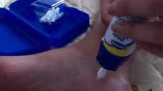 Dr Scholls Dual Action Freeze away wart remover how to for large warts [upl. by Alper]