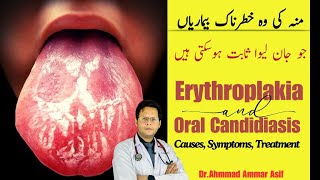 What Is Erythroplakia amp Oral Candidiasis  Causes Symptoms Treatment [upl. by Nabois814]