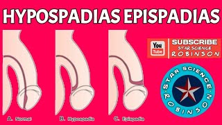 HYPOSPADIAS EPISPADIAS IN STAR SCIENCE ROBINSON [upl. by Alidis96]