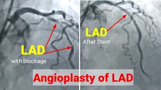 Angioplasty ll Angioplasty procedureRadial access Stenting of LAD हार्ट मैं छल्ला कैसे लगाते है [upl. by Ettevi405]