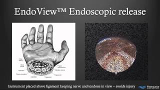 EndoTech® Endoscopic Carpal Tunnel Release  Phoenix Arizona [upl. by Teraj]