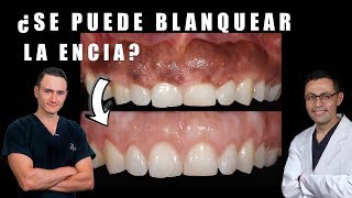 ¿Cómo se quitan las manchas oscuras de la encía te decimos cómo  Peeling Gingival [upl. by Ellenrad]