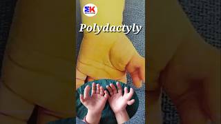 Polydactyly  What is Polydactyly shorts MedicineKnowledgehindi [upl. by Gerrald]