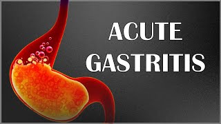 Acute Gastritis  Signs amp Symptoms Causes Pathogenesis Complications Diagnosis amp Treatment [upl. by Aileduab]