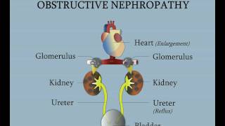 Posterior Urethral Valves  Obstructive Nephropathy [upl. by Yuht198]