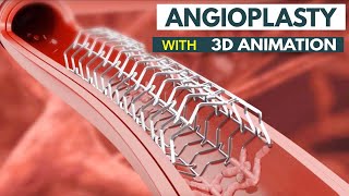 Angioplasty Procedure Explained How It Saves Lives  What Is Angioplasty StepbyStep Explanation [upl. by Eiduj]