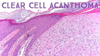 Clear Cell Acanthoma Dermpath in 5 Minutes pathology dermatology dermatopathology [upl. by Aciria]