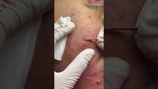 Best Pimple Popping 07 beautiful blackheads sacdepspa [upl. by Jairia]