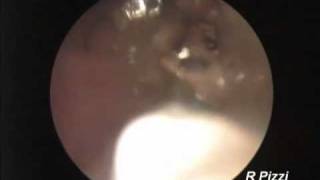 Bearded dragon endoscopic retreival of gastric foreign body [upl. by Quintessa78]