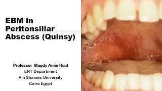 EBM in Peritonsillar Abscess Quinsy [upl. by Cammy]