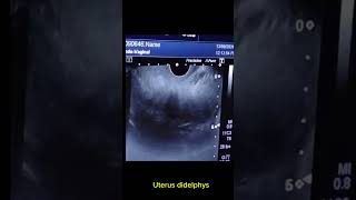 Uterus didelphys with right adnexal haemorrhage cyst [upl. by Sadowski578]