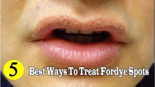 5 Best Ways to Remove Fordyce Spots Naturally at Home YouTube [upl. by Meikah]