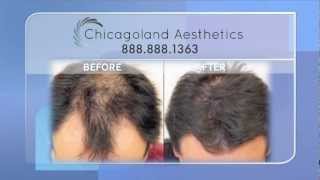 Neograft Hair Transplant in Chicago [upl. by Humfrid]