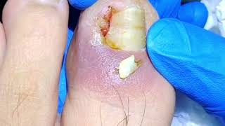 Satisfying Ingrown Toenail Removal by Professional [upl. by Giacinta]