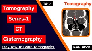 CT Cisternography  Tomography Series 1  RadTutorial [upl. by Ggerg]