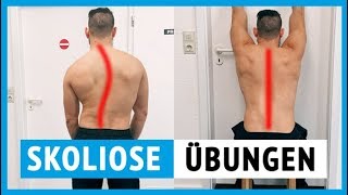 Skoliose Übungen vom Physiotherapeuten für zu Hause [upl. by Enohsal439]