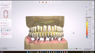 CUDCLD with Implants [upl. by Notgnihsaw]