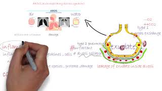 ARDS acute respiratory distress syndromeشرح [upl. by Ysdnil]