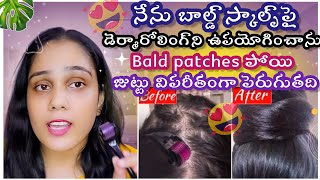 SHOCKING RESULTS 😲✨✨ ఇది Doctors hairgrowth కోసం ఉపయోగిస్తారు ✨ [upl. by Kinnon238]