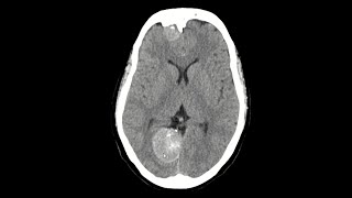 Falx meningioma MRI brain [upl. by Bik510]