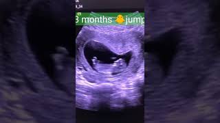 Level 2 ultrasound गर्भवती का महत्वपूर्ण अल्ट्रासाउंड [upl. by Nertie]