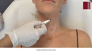 Profhilo Bio Aesthetic Points BAP Neck Technique explained by Dr Gabriel Siquier [upl. by Olivier609]