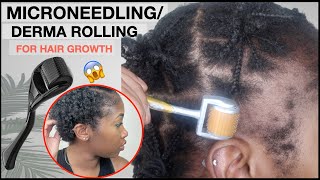 MICRONEEDLINGDERMA ROLLING FOR EDGE GROWTH  Two Month Update  TRACTION ALOPECIA 🚨 NO MINOXIDIL [upl. by Sand]