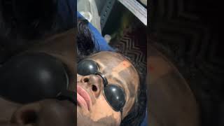 doctor carbonlaserfacial laserskinrejuvenation skincare [upl. by Faso98]