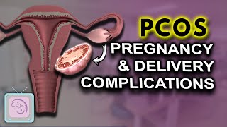 PCOS Pregnancy complications  High risk  Birth Defects [upl. by Nary180]