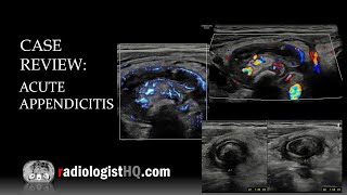 Ultrasound of Acute Appendicitis [upl. by Renaxela]